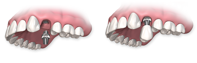 Dental Implant Procedure