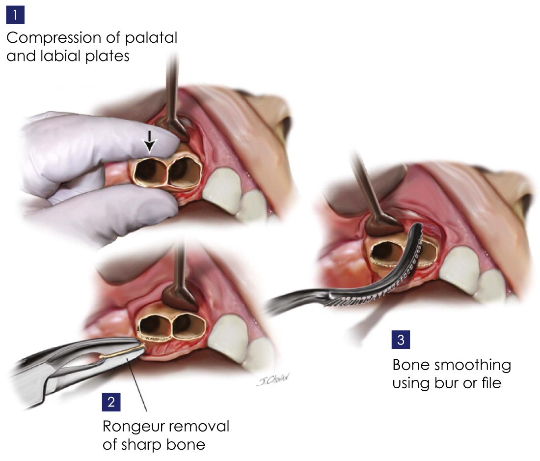 Ridge Augmentation