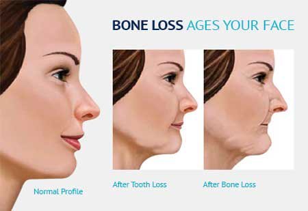 bone resorption