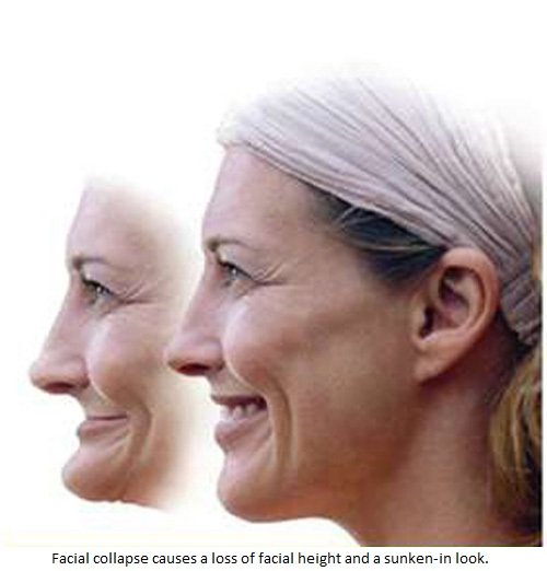 bone resorption